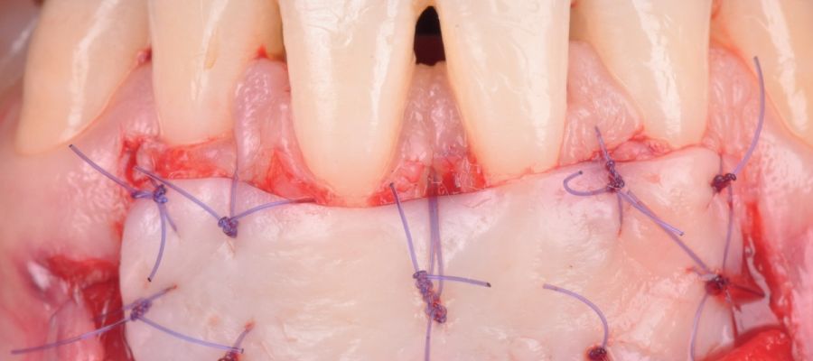 Formation clinique greﬀe gingivale